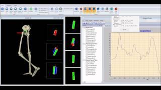 Gait analysis with bluetooth inertial sensors