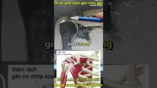 NHẬN BIẾT RÁCH GÂN TRÊN GAI TRÊN PHIM CỘNG HƯỞNG TỪ