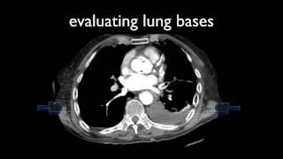 Ultrasound to Manage Acute Dyspnea at the Bedside