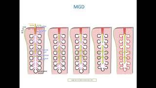 [Online Seminar] Sruthi Srinivasan: Evaluating MGD and Meibography with the Keratograph® 5M