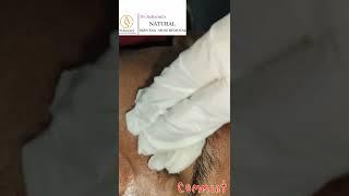 Freckles Removal  Full Proceger| Dr.Ashwinis Permanent Cosmetic | Natural Brows Academy