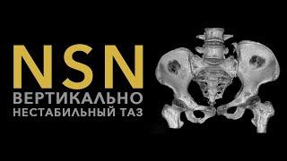 NsN Вертикально нестабильный таз