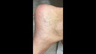 Spider Veins VIP Health and Laser