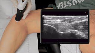Medial Elbow PRP Injection