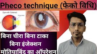 Phaco technique/ cataract surgery use by pheco technique/फेको विधि /मोतियाबिंद/मोतियाबिंद का ऑपरेशन