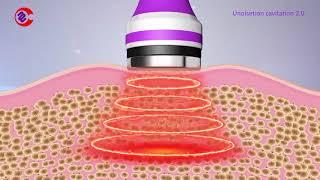 How Ultrasonic Cavitation Work? How Ultrasonic Cavitation Remove Fat? What Is  Cavitation Machine?