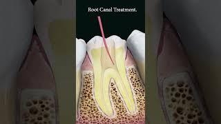 Root canal treatment