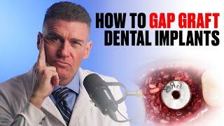 MASTER Gap Grafting for Dental Implants: Material Selection & Technique Explained