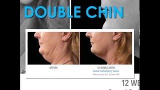 CoolSculpting Skin Perfect Rancho