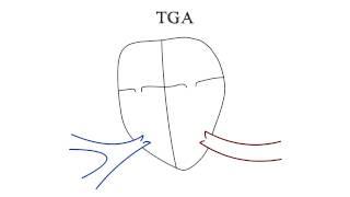 Transposition of the Great Arteries (TGA)