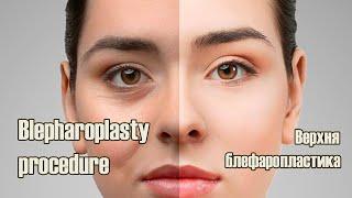 Blepharoplasty / Блефаропастика. Вся операція з коментарями хірурга та пацієнтки