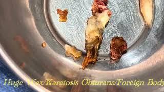 Huge Painful Wax in Ear / Foreign Body / Karatosis Obturans  treatment .