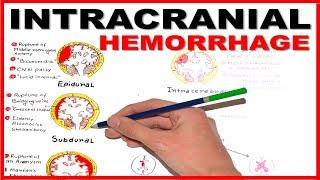 Intracranial Hemorrhage- Epidural/Subdural/Subarachnoid overview