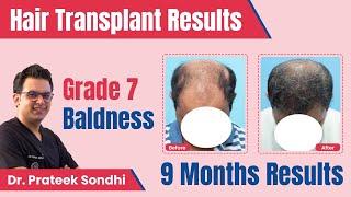 Hair Transplant Results 9 Months | Grade 7 Baldness | Derma Circles