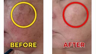 Red Light Therapy For Face Before And After: UNBELIEVABLE!