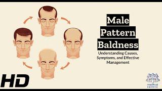 Male Pattern Baldness Explained: Everything You Need to Know