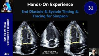 End Diastole & Systole Timing & Tracing for Simpson: hands-on Experience 31