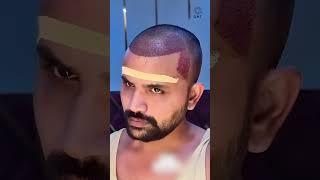 Youtuber Nadeem Bunny (Topa Bhai)  Nine Months Hair Transplant Result #shorts#hairtransplant