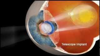 Implantable Mini Telescope for Macular Degeneration at the Gavin Herbert Eye Institute