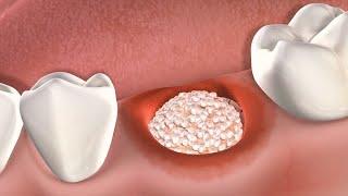 Ghép xương cấy răng implant | Implant bone graft