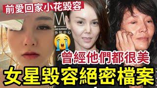慘！前愛回家小花「不幸毀容」面上留很大疤痕 ！女星毀容絕密檔案！曾經他們都很美！梁茵黎愛蓮 SHE既任家萱 俞灝明 薛芷倫 洪金寶 吳志雄 戴良純 伍智恆 陳思齊 林志穎 胡歌 邵音音同埋林嘉華