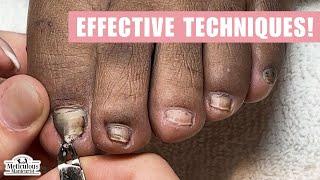 How to Fix Ingrown Toenail at Home