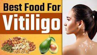 Best Diet Plan For Vitiligo Patient | Best Food For Vitiligo ( White Patches ) | Dr health