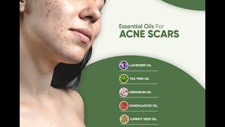 Best Essential Oils for Acne