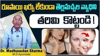 బొల్లికి శాశ్వత పరిష్కారం ఇదే | How to Treat Vitiligo Spots Naturally in Telugu | Socialpost Health