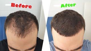 Hair Transplant Time Lapse (0 - 6 Months)