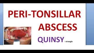 ENT PeriTonsillar Abscess Quincy Neck space infection Uvula Hot Potato Voice