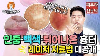 [수술외상흉터 정복 6탄] 이런 흉터까지 치료가 된다고? 인중 흉터/흰색 흉터/백색 흉터/튀어나온 흉터 레이저 치료 방법 대공개!