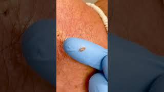 #shorts Blackhead Squeezed Out | CONTOUR DERMATOLOGY