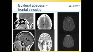 Imaging in CNS infections