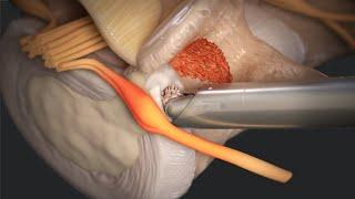 Transforaminal Endoscopic Discectomy