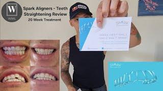 Investing in Yourself - 20 Week Spark Aligner / Invisalign Review - Straighter Teeth Guaranteed 