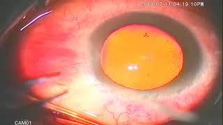 phaco in nuclear cataract quick chop dr mohamed attar