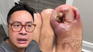 IS THIS THE WORSE INGROWN YOU EVER SEEN?