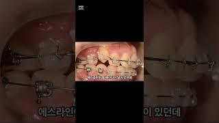 인터넷에서 봤는데, 에스라인 장치가 잘 깨지나요?  #교정중생기는 #프라임S치과