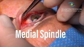 Medial Spindle for Punctal Ectropion