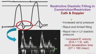 Constrictive Pericarditis