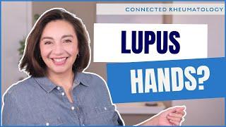 The 3 ways Lupus can affect your hands - a Rheumatologist explains