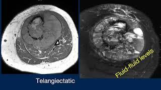 Dr. Geoffrey Riley Presents: 20 in 10 osteosarcoma