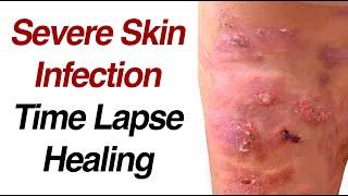 Severe Skin Infection Healing Time Lapse: Impetigo to Cellulitis to Resolution (0 to 30 days)