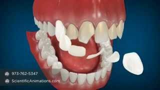 Cosmetic Dentistry Procedures - Dental Animation