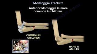 Monteggia Fracture - Everything You Need To Know - Dr. Nabil Ebraheim