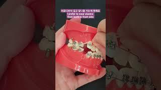 2급 교정고무줄 거는 방법, How to wear Class II elastics #교정 #교정고무줄 #shorts #교정전문의 #교정치료 #치아교정