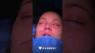 Open Rhinoplasty surgery in Iran 2023 - AvaMedi 05