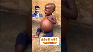 kwashiorkor #protein deficiency #marasmus #child illness #shorts