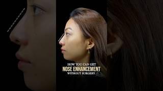 Non-Surgical Nose Enhancement | Dr. Adarsh Tripathi #beauty